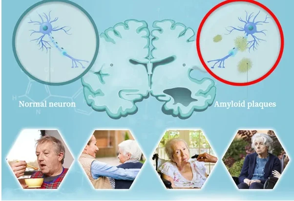laser light for parkinsons disease1