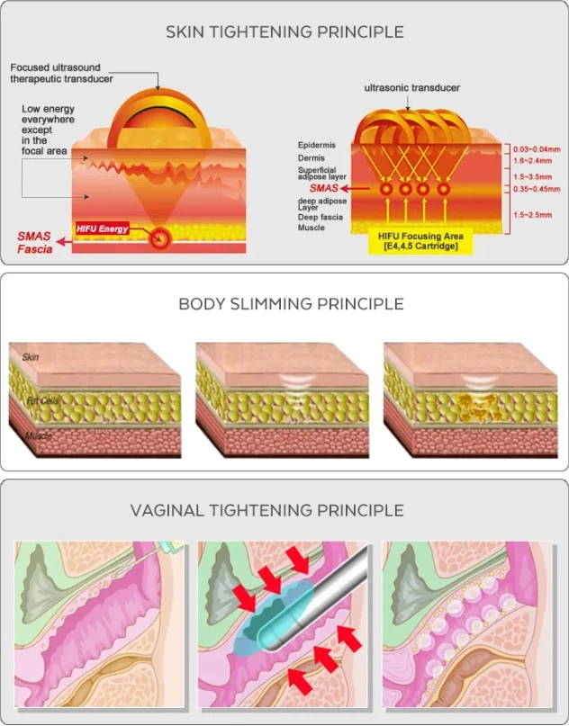 low level pelvic floor laser treatment1