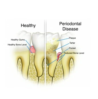 laser treatment for dental bone loss2