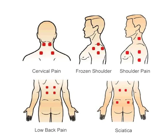 laser therapy for pain1