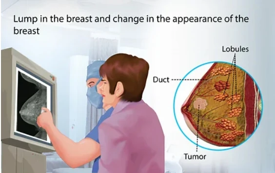 breast cancer device1