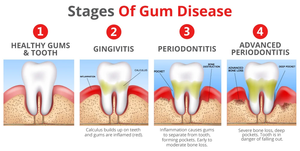 Dental laser treatment for the elderly
